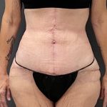 Massive Weight Loss Before & After Patient #15961
