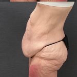 Massive Weight Loss Before & After Patient #15961
