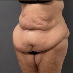 Massive Weight Loss Before & After Patient #15963