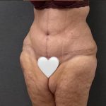 Massive Weight Loss Before & After Patient #15963